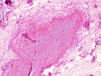 calcinosis circumscripta, german shepherd