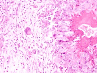 liver granuloma, chicken