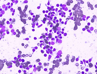 small cell lymphoma - hand mirrors